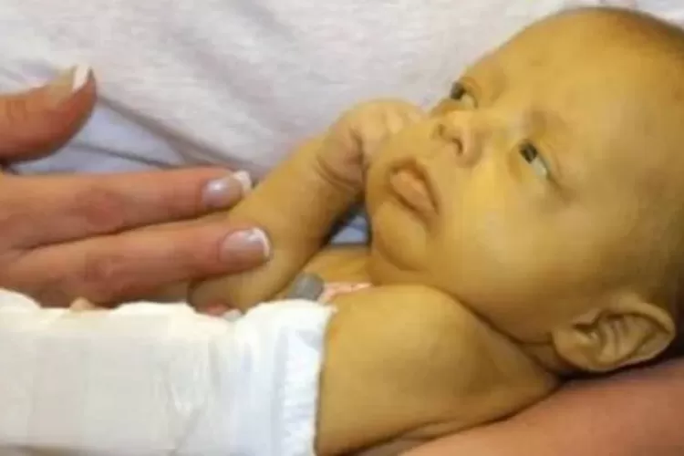 Penyakit Kuning pada Bayi: Gejala, Perawatan, dan Pencegahannya
